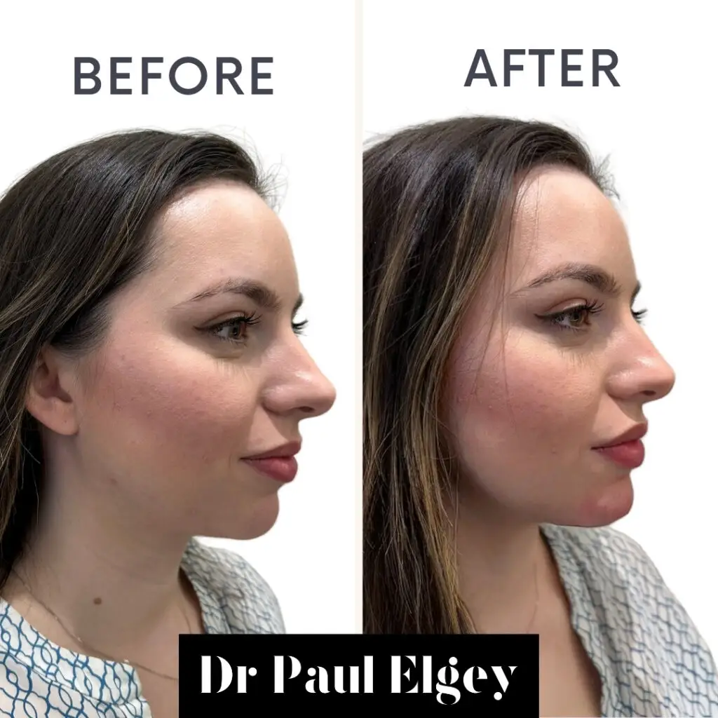 Chin filler London treatment showing before and after treatment.