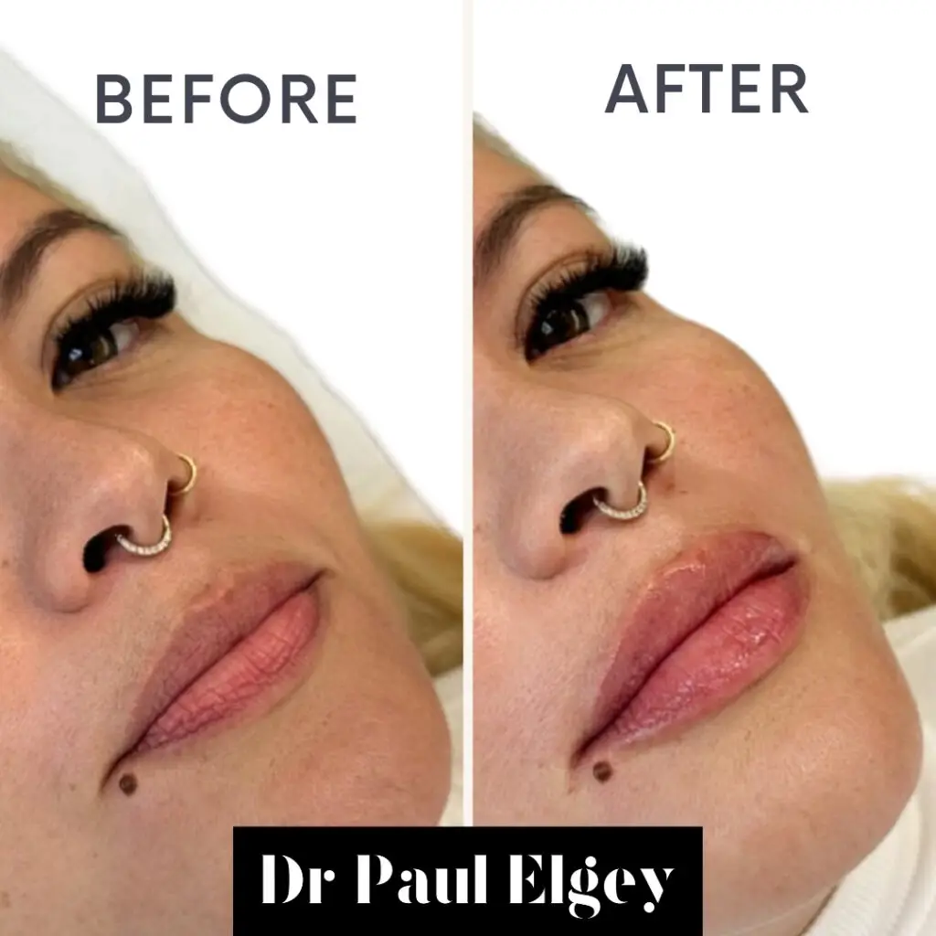 Lip filler London treatment image before and after.