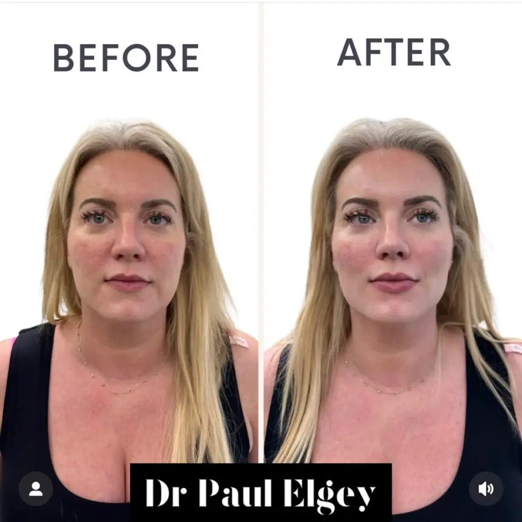 Midface filler London treatment images showing before and after treatment.