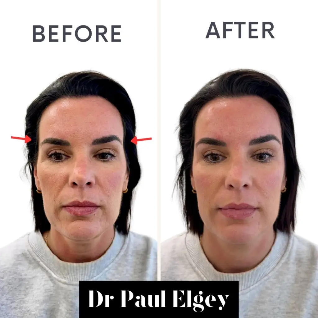 Image showing temple filler London treatment with before and after image.