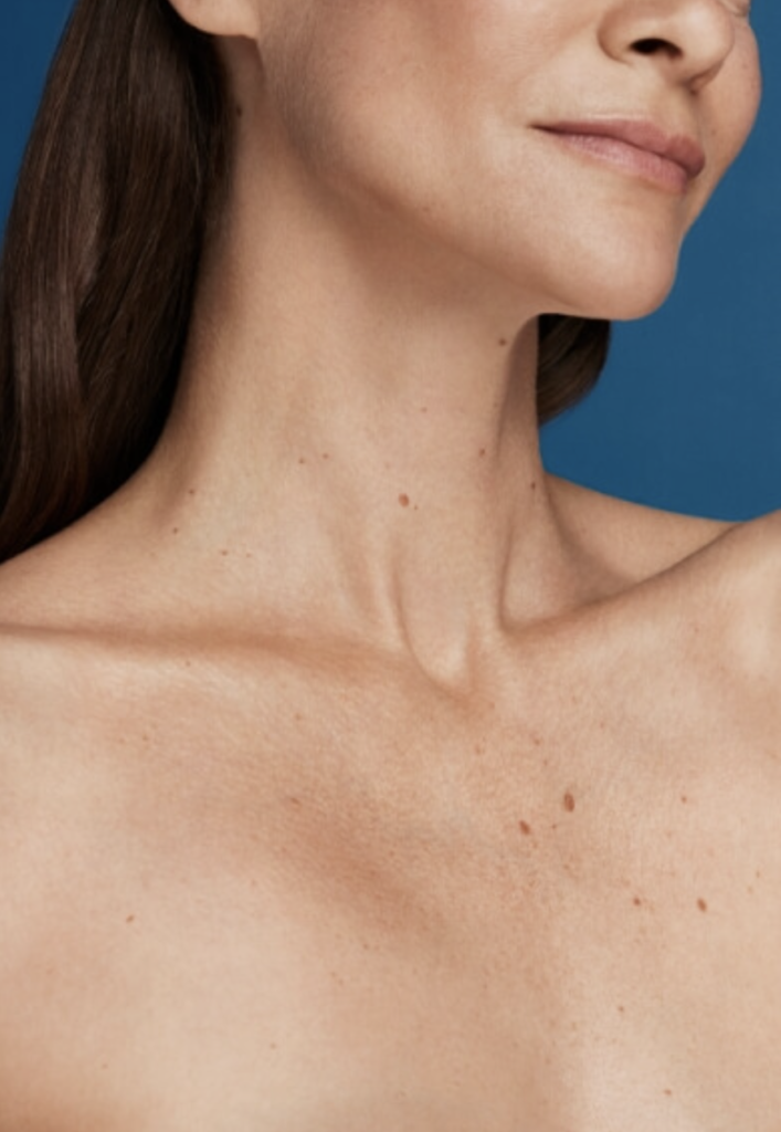 The Science and Beauty of Radiesse Image of decolletage of woman after treatment with Radiesse