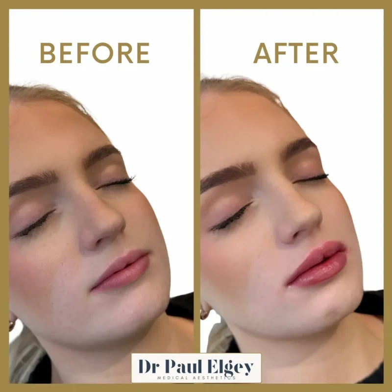 Lip filler before and after showing subtle volume enhancement, improved hydration and natural lip definition by Dr Paul Elgey London