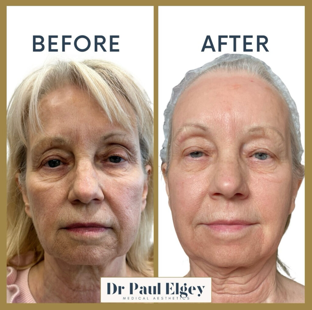 Before and after UltraClear laser treatment showing improved skin texture, pigmentation, and overall skin quality at one week.