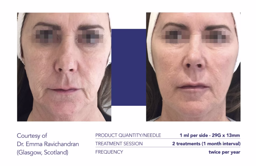 Profhilo before and after results showing improved skin hydration and texture