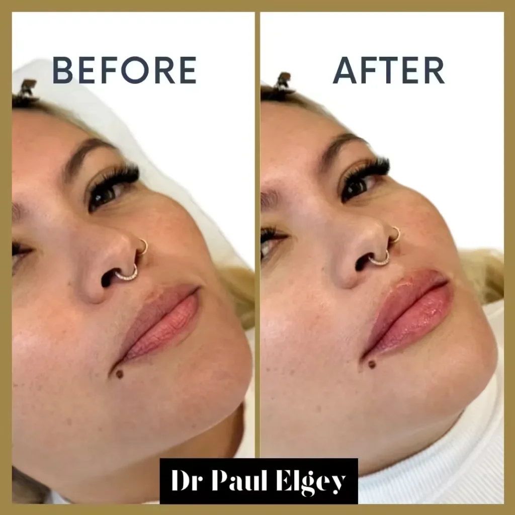 Lip Filler Before & After