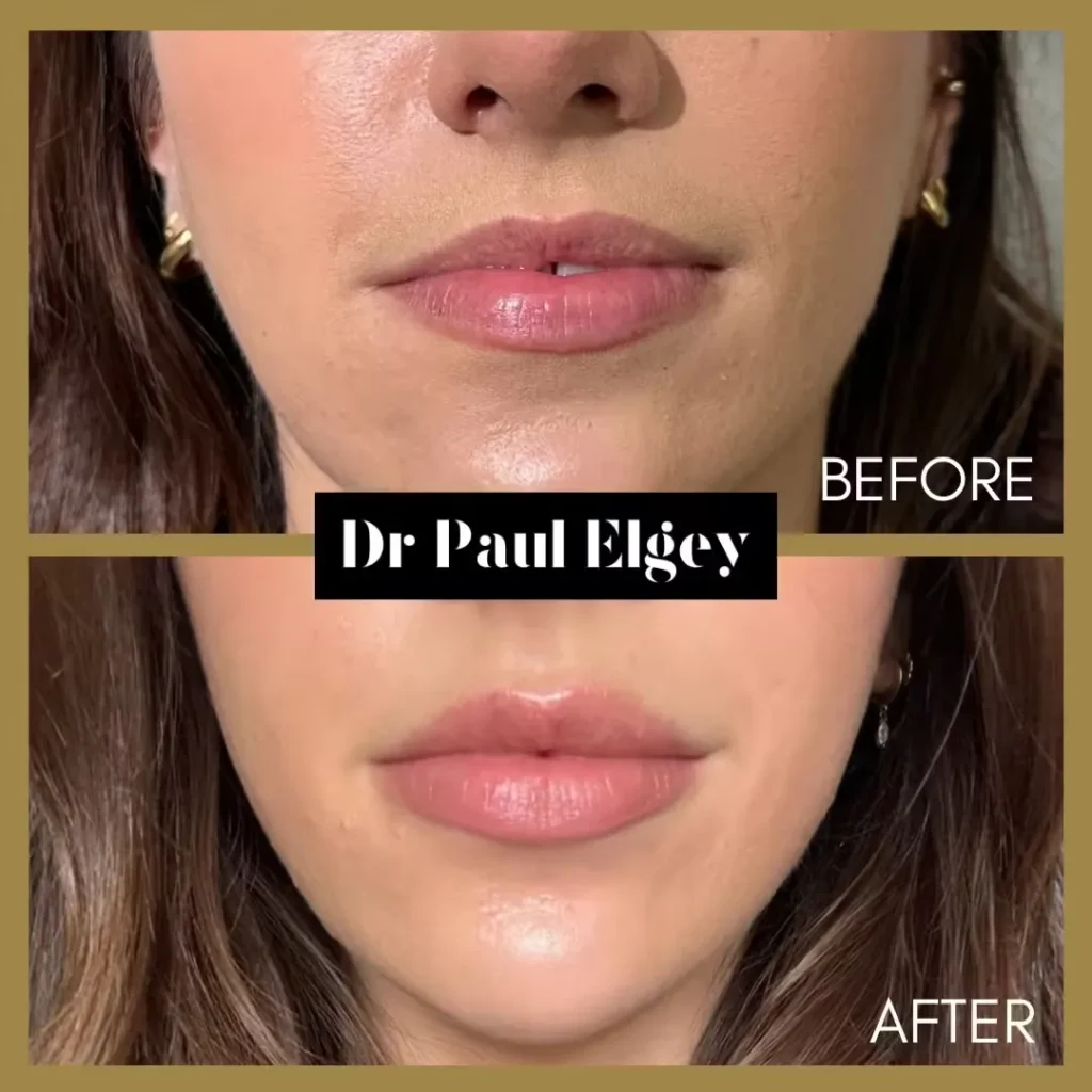 Lip Filler Before & After