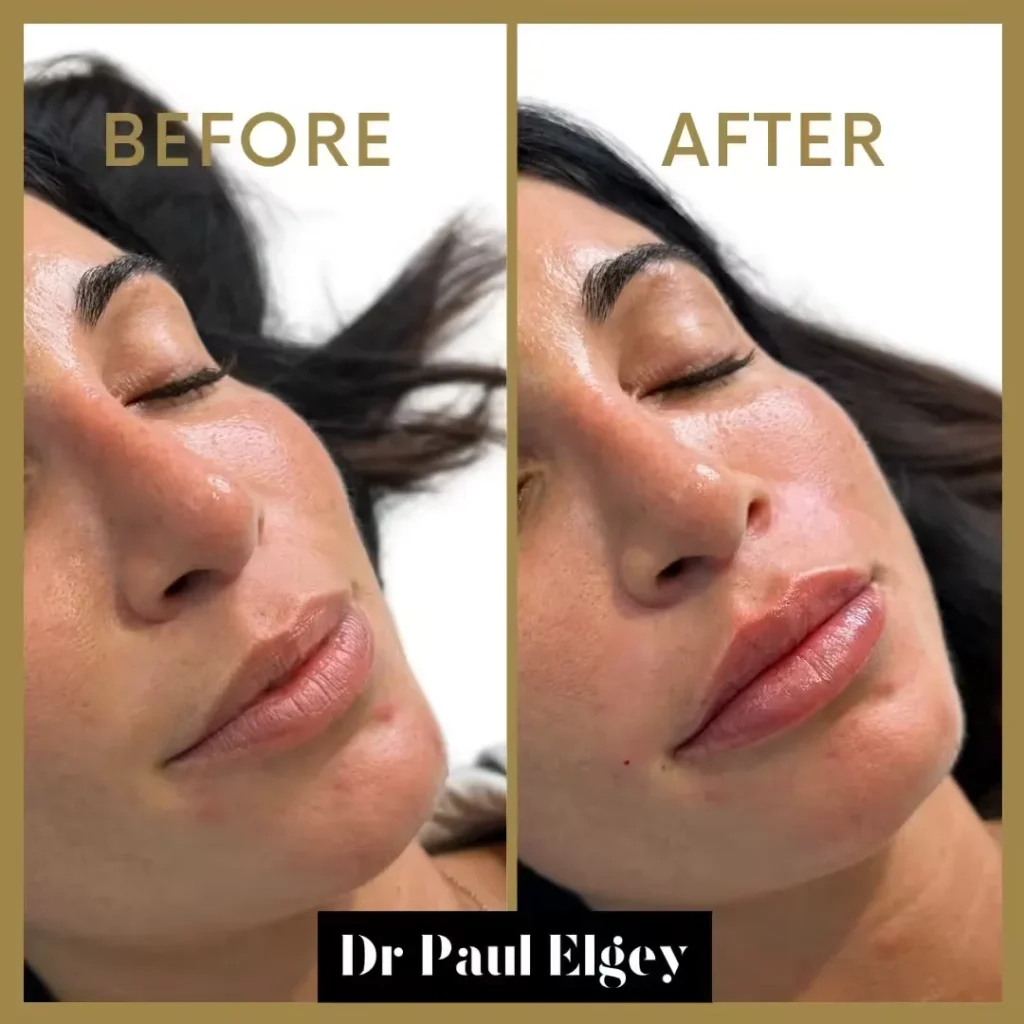 Lip Filler Before & After