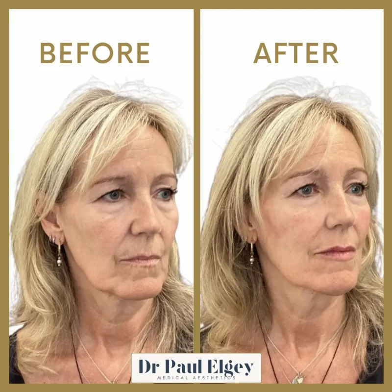 Full face rejuvenation before and after showing improved facial contours and volume restoration by Dr Paul Elgey