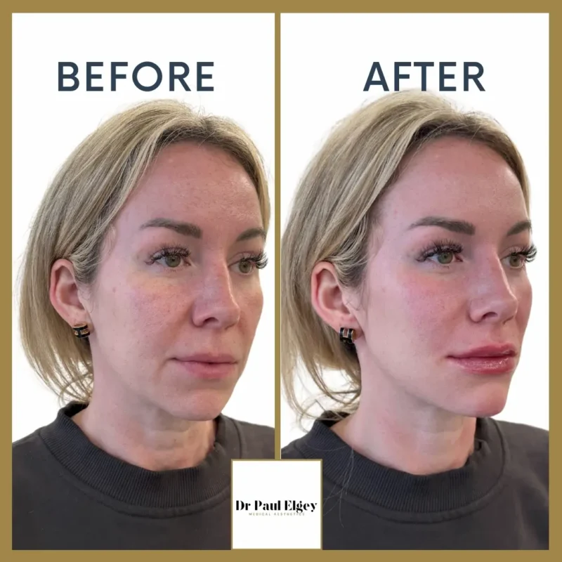 Full face rejuvenation close up before and after showing improved skin texture and subtle lifting by Dr Paul Elgey London