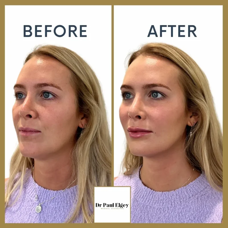 Full face rejuvenation before and after showing improved facial balance, skin quality and subtle lifting by Dr Paul Elgey London