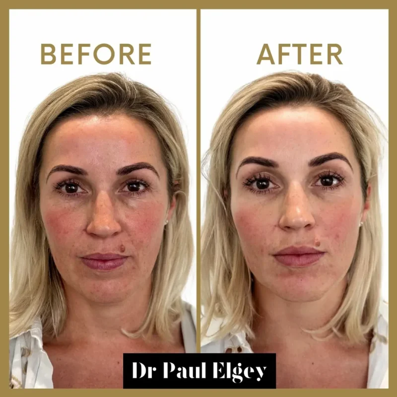 Full face rejuvenation before and after showing improved facial symmetry, skin quality and natural rejuvenation by Dr Paul Elgey London