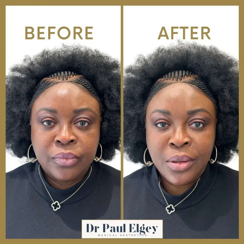 Full face rejuvenation before and after showing improved symmetry and facial harmony by Dr Paul Elgey London