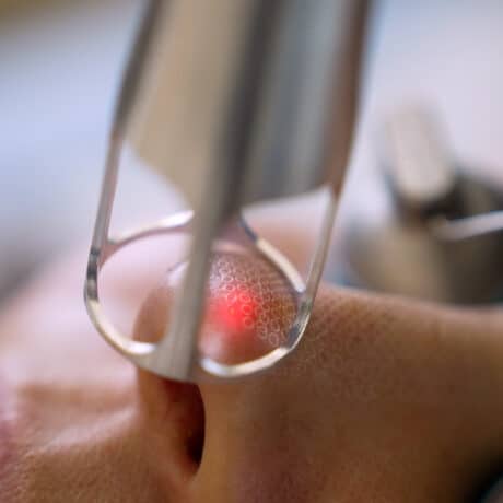 UltraClear 3D Miracle laser treatment around the eye using a protective ocular shield for precise skin rejuvenation.
