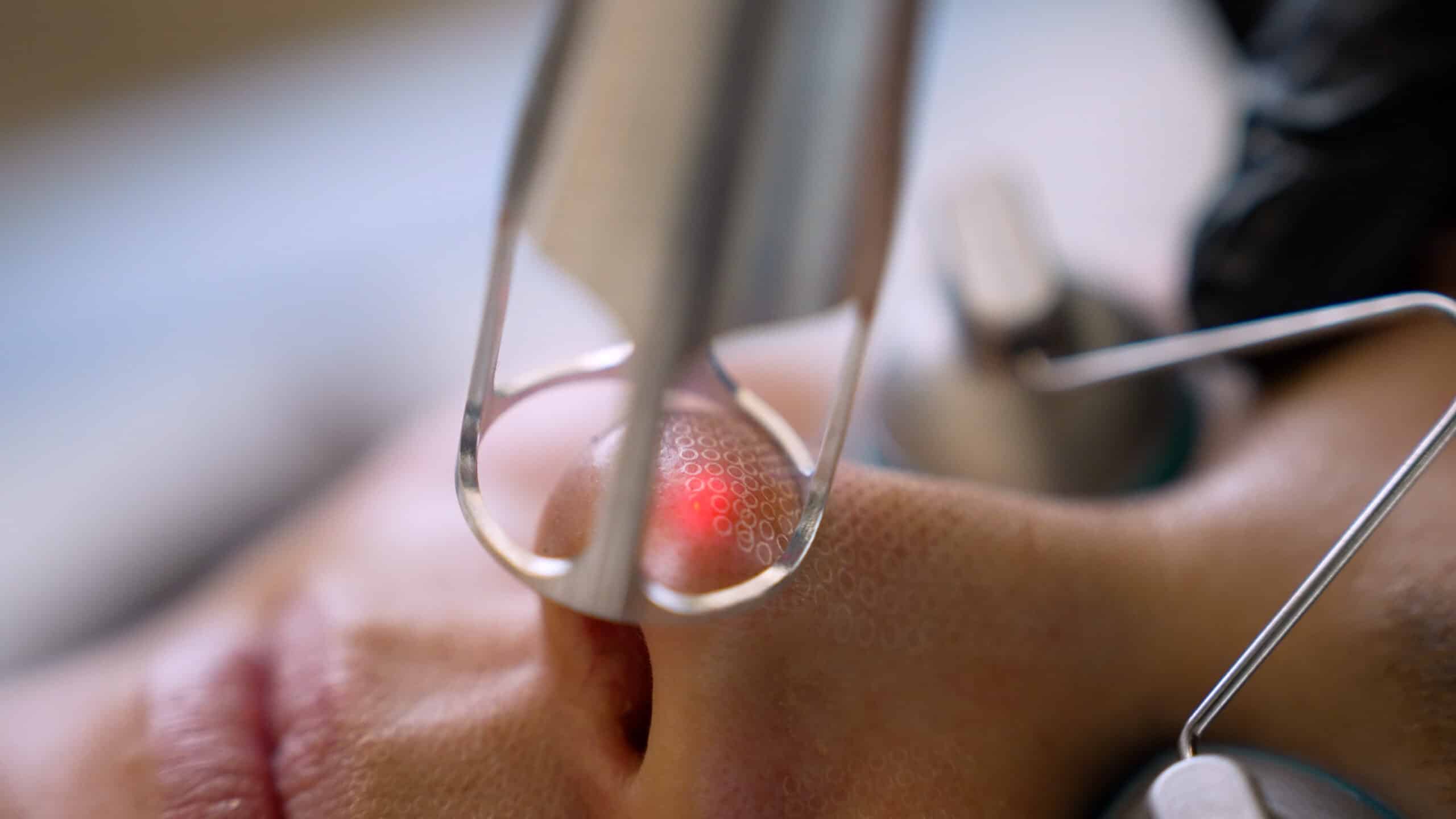 UltraClear 3D Miracle laser treatment around the eye using a protective ocular shield for precise skin rejuvenation.